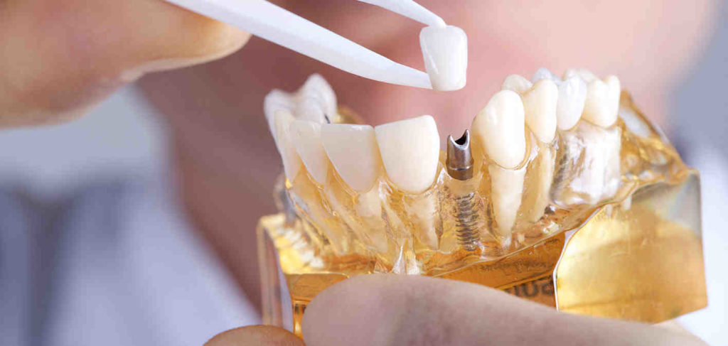 Implant dentist san diego