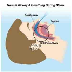 San diego sleep apnea dentist