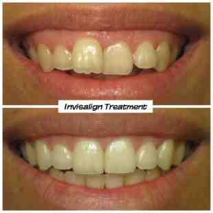 Can you get Invisalign without seeing a doctor?