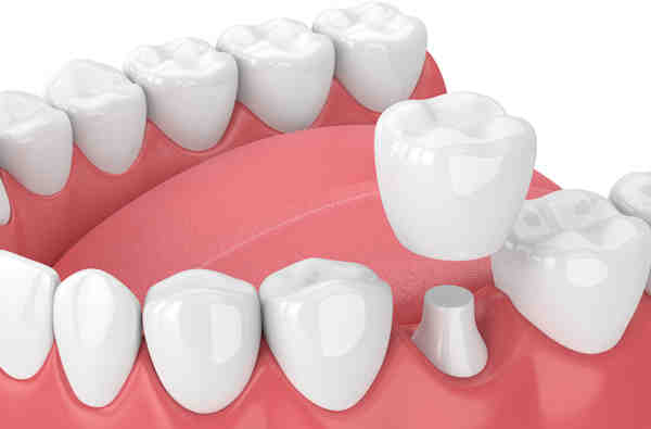 Dentist san diego crowns