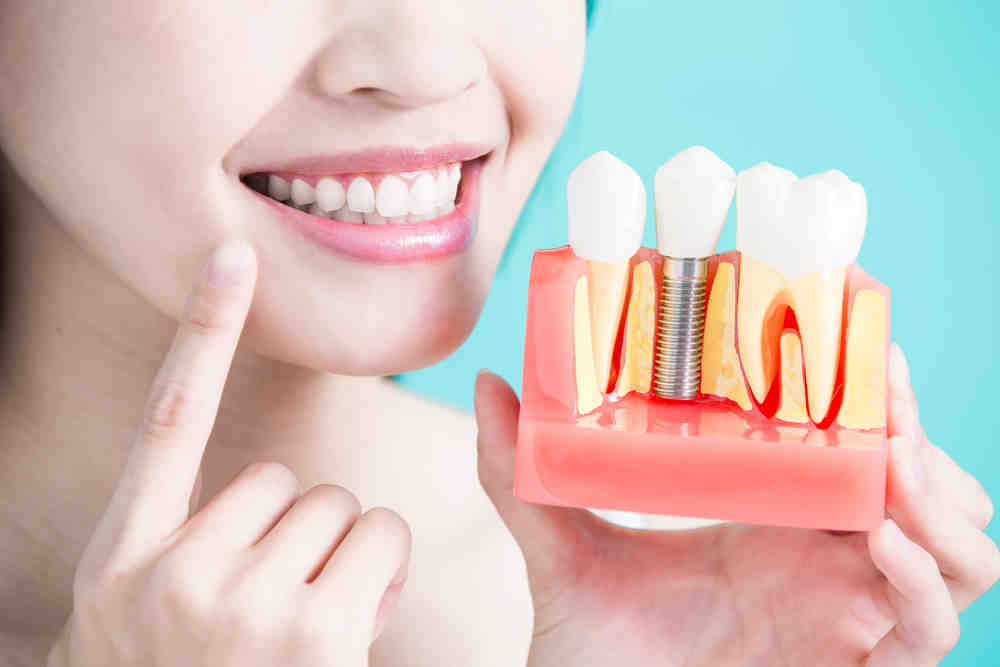 How much do dental implants cost in San Diego?