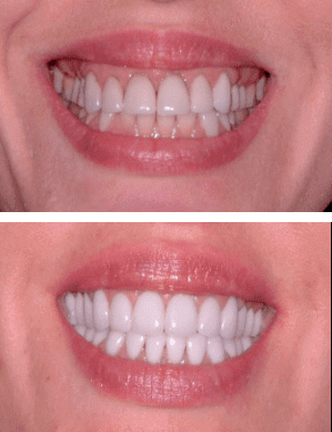 Veneers dentist san diego